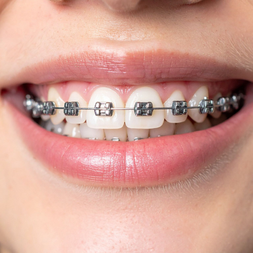 Progetto senza titolo (2) Apparecchio ai denti per bambini ad Asti